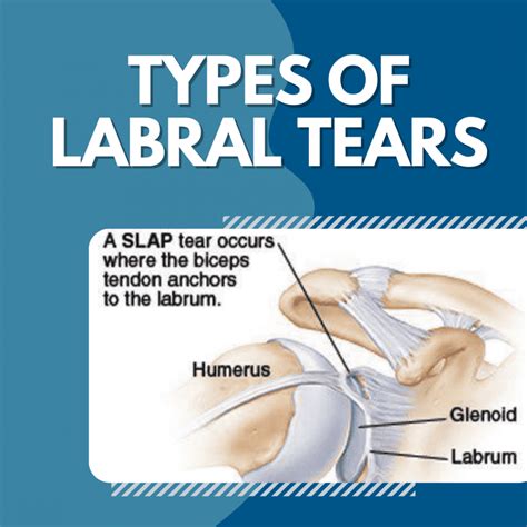 positive vs negative labral tear